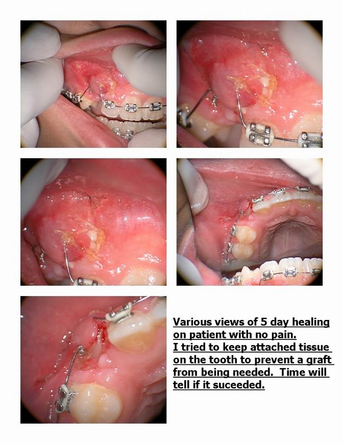 Resize of Orthodontic exposure of canine pg 3.jpg